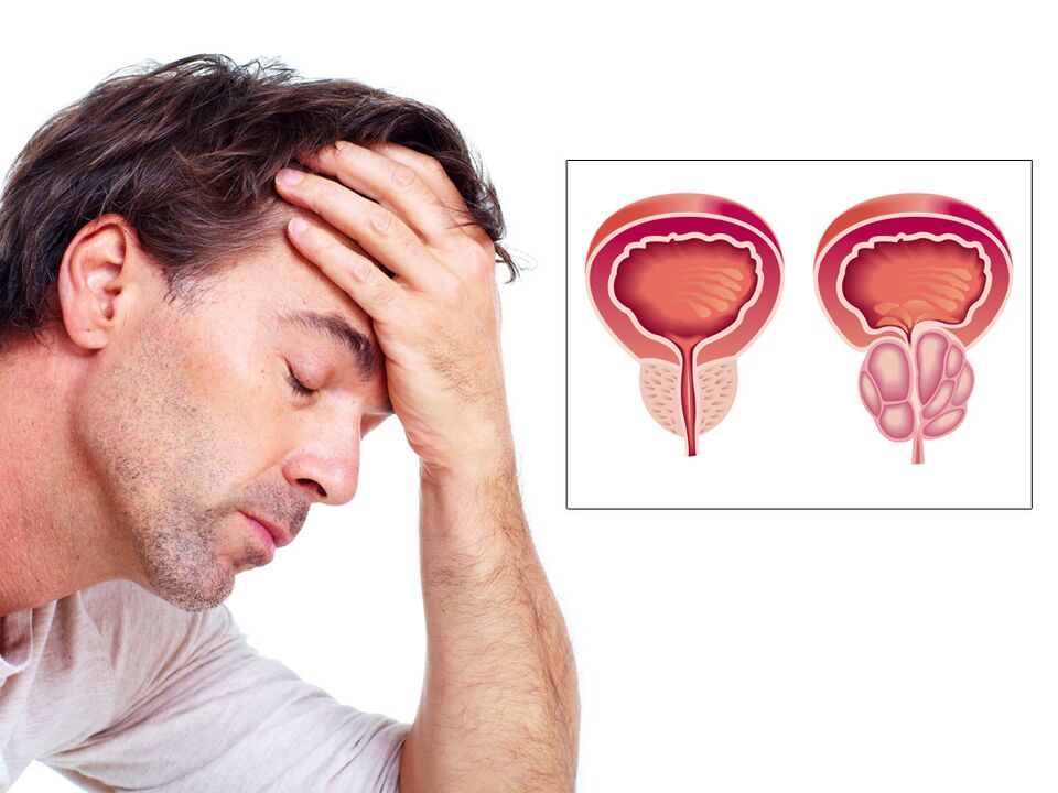 adenom prostate sa impotencijom